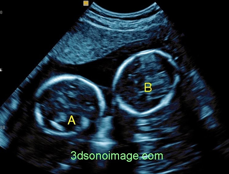 Exterior of 3D Sono Image